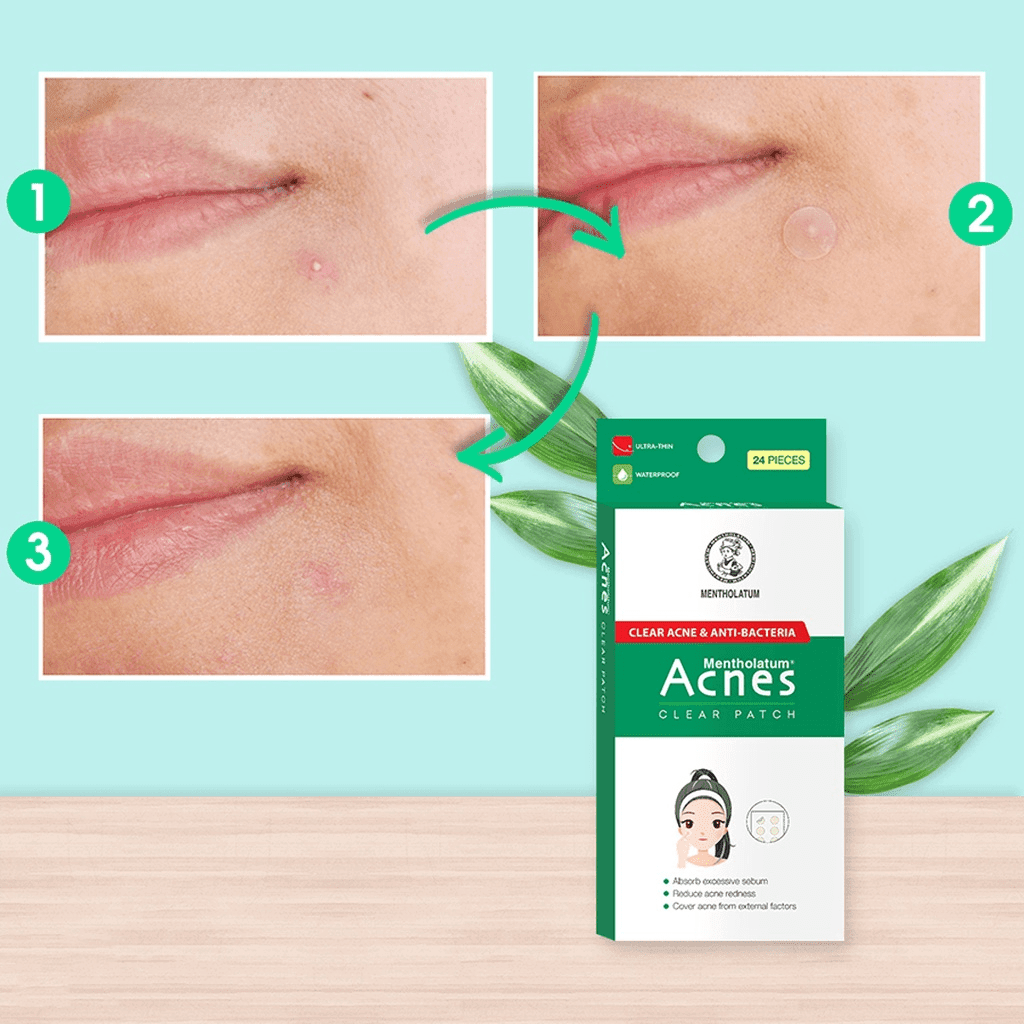 Miếng dán mụn Acnes Clear Patch