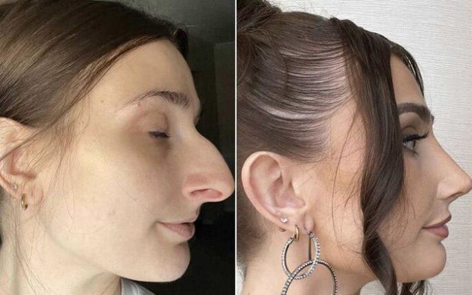 Chiếc mũi 270 triệu giúp cô gái Mỹ dứt áo hôn nhân đau khổ