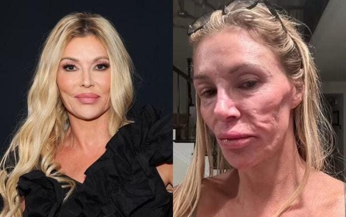 Cuộc chiến 5 năm sửa mặt biến dạng vì filler của sao truyền hình